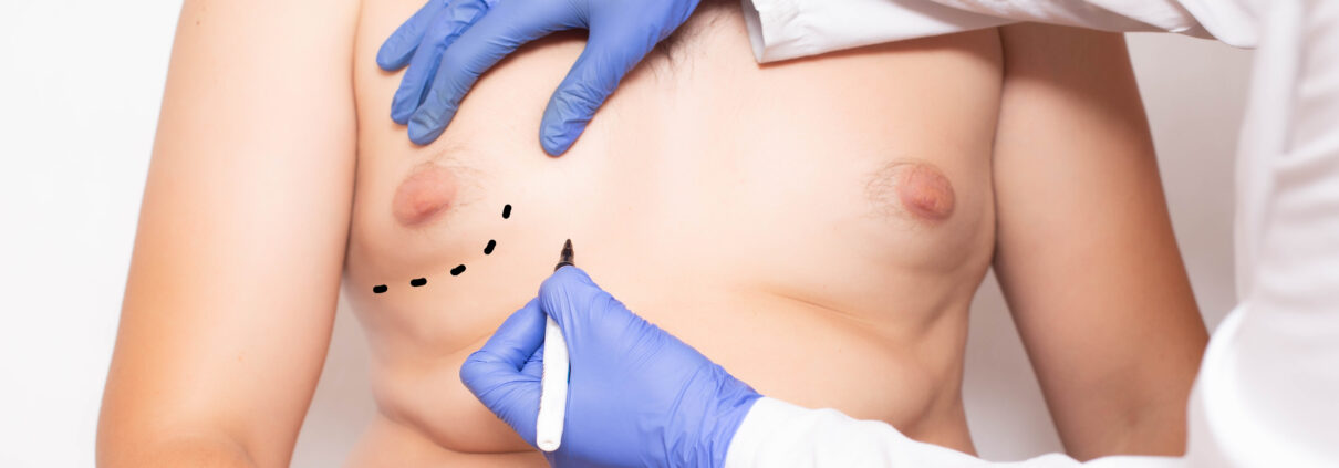 Doktor plastic surgeon preparation before surgery to reduce breasts in men, gynecomastia, lipolysis, liposuction